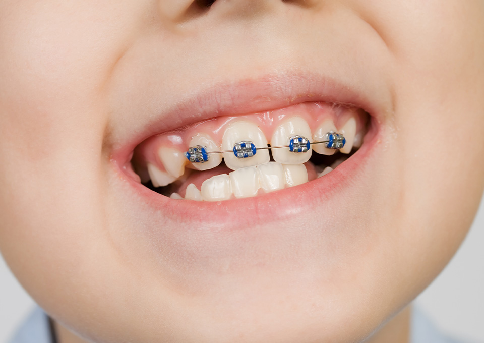 矯正装置の装着