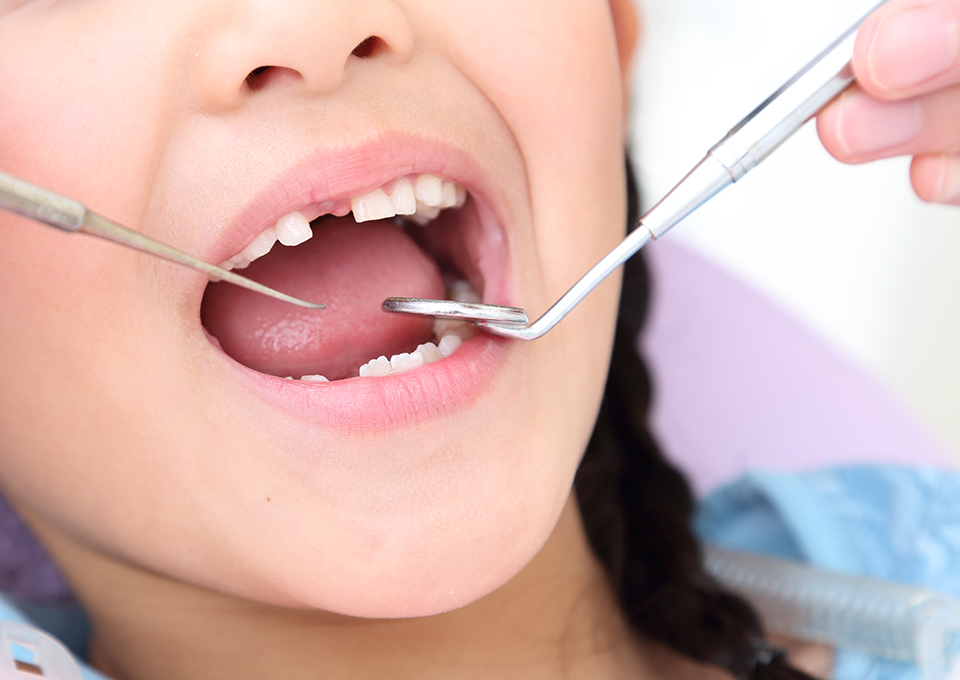 乳歯のむし歯は進行しやすい