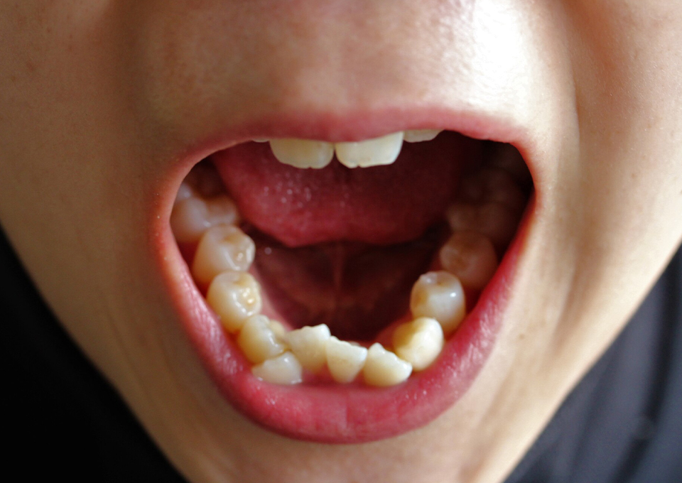 歯並びが悪くなる