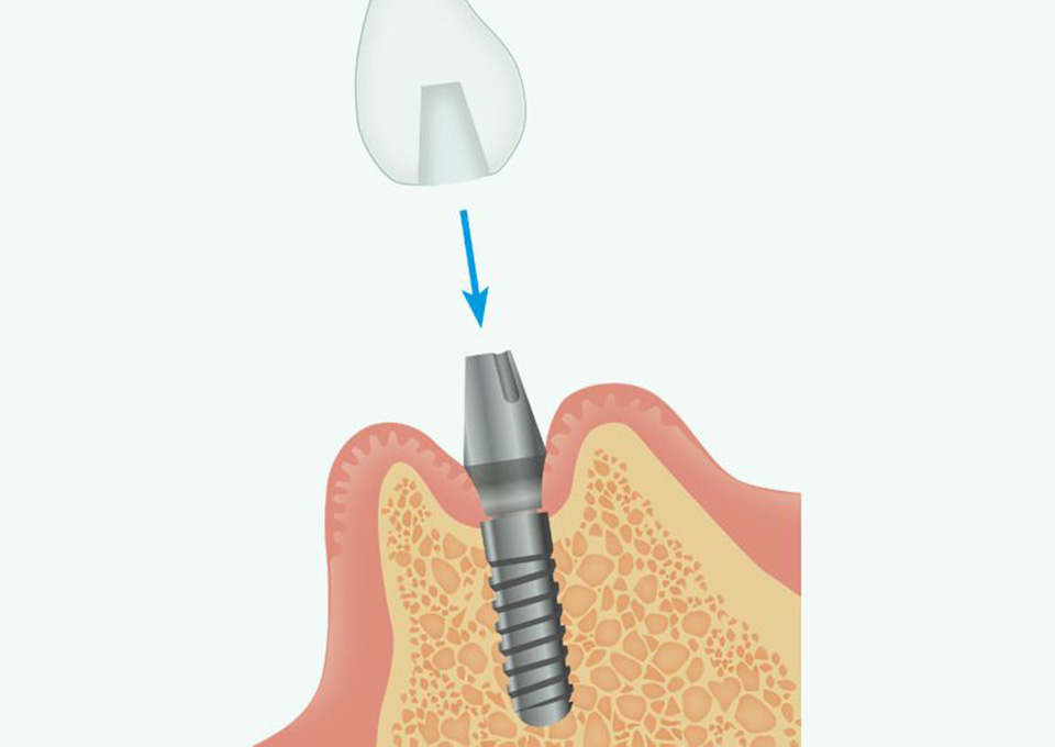 義歯の製作・仮歯の装着