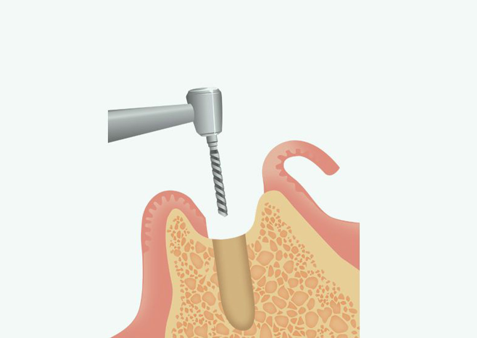 インプラント体の埋め込み