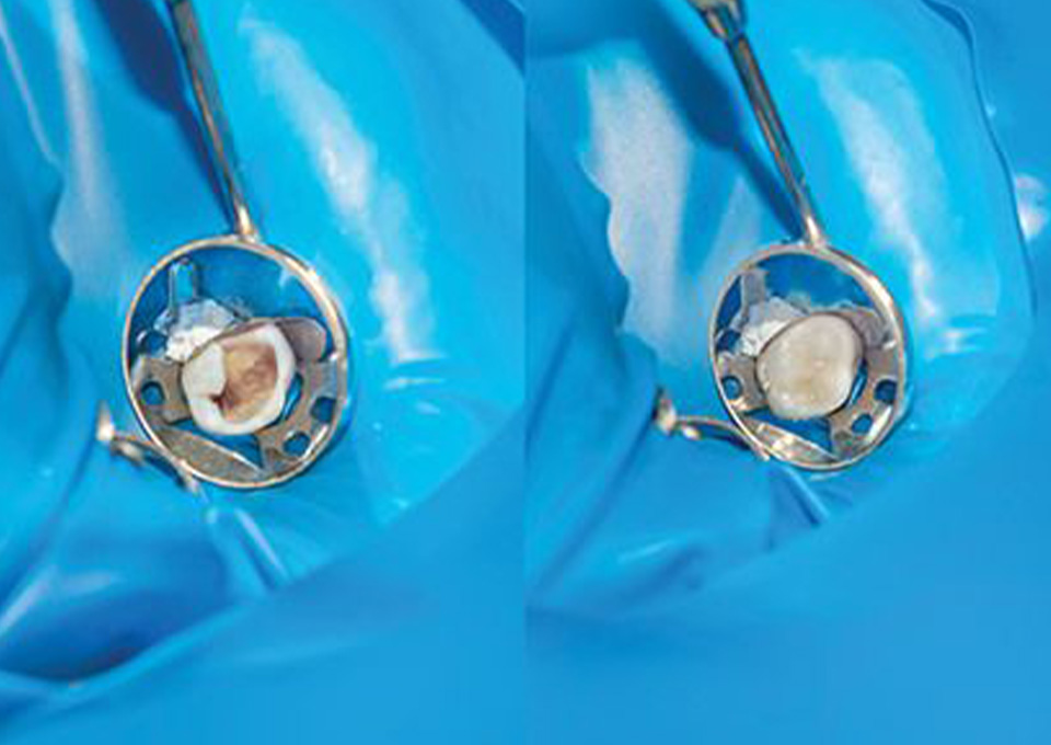 詰め物・被せ物を装着する