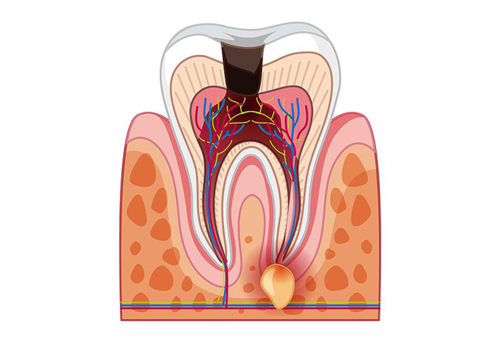 むし歯が神経に達すると……