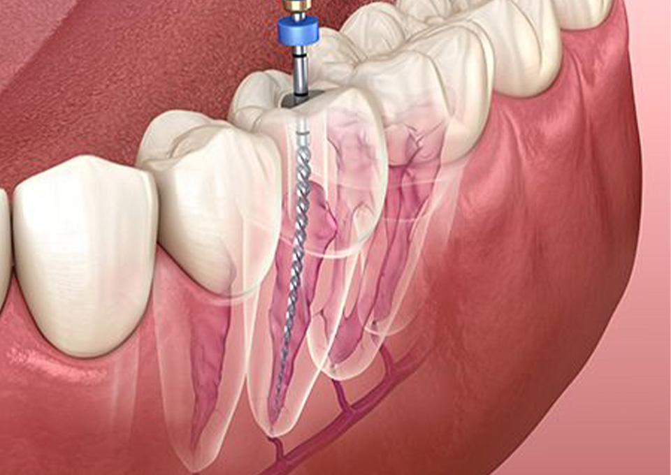 神経を取り除く根管治療