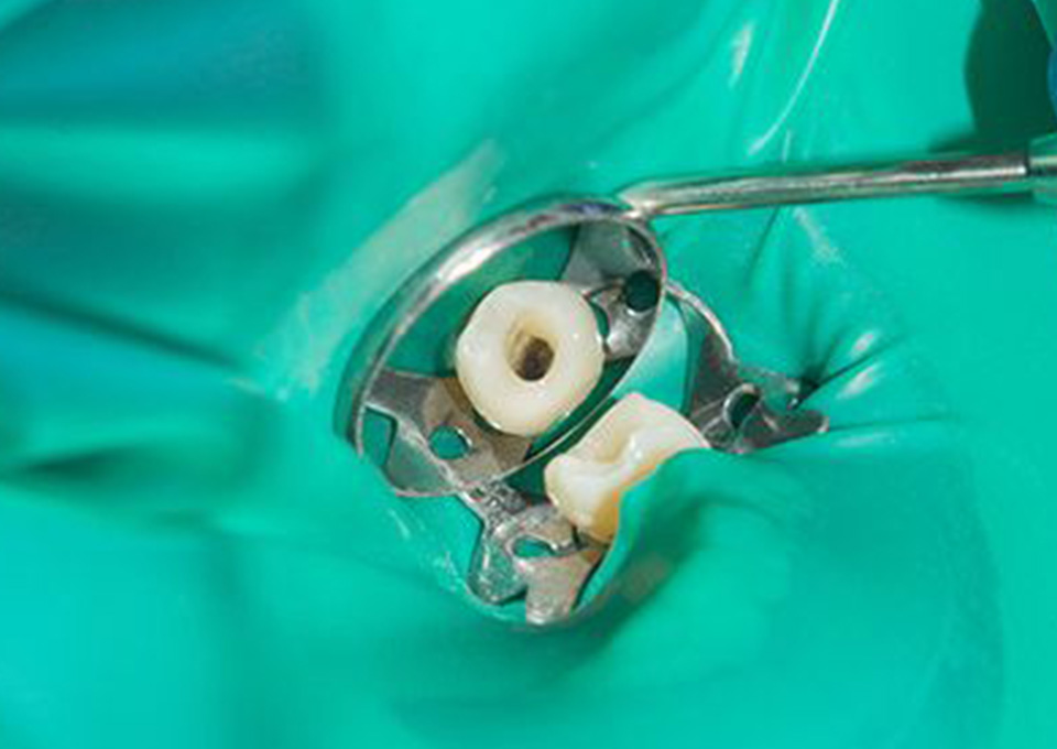 根管内を洗浄する